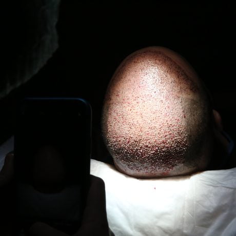 hair transplant