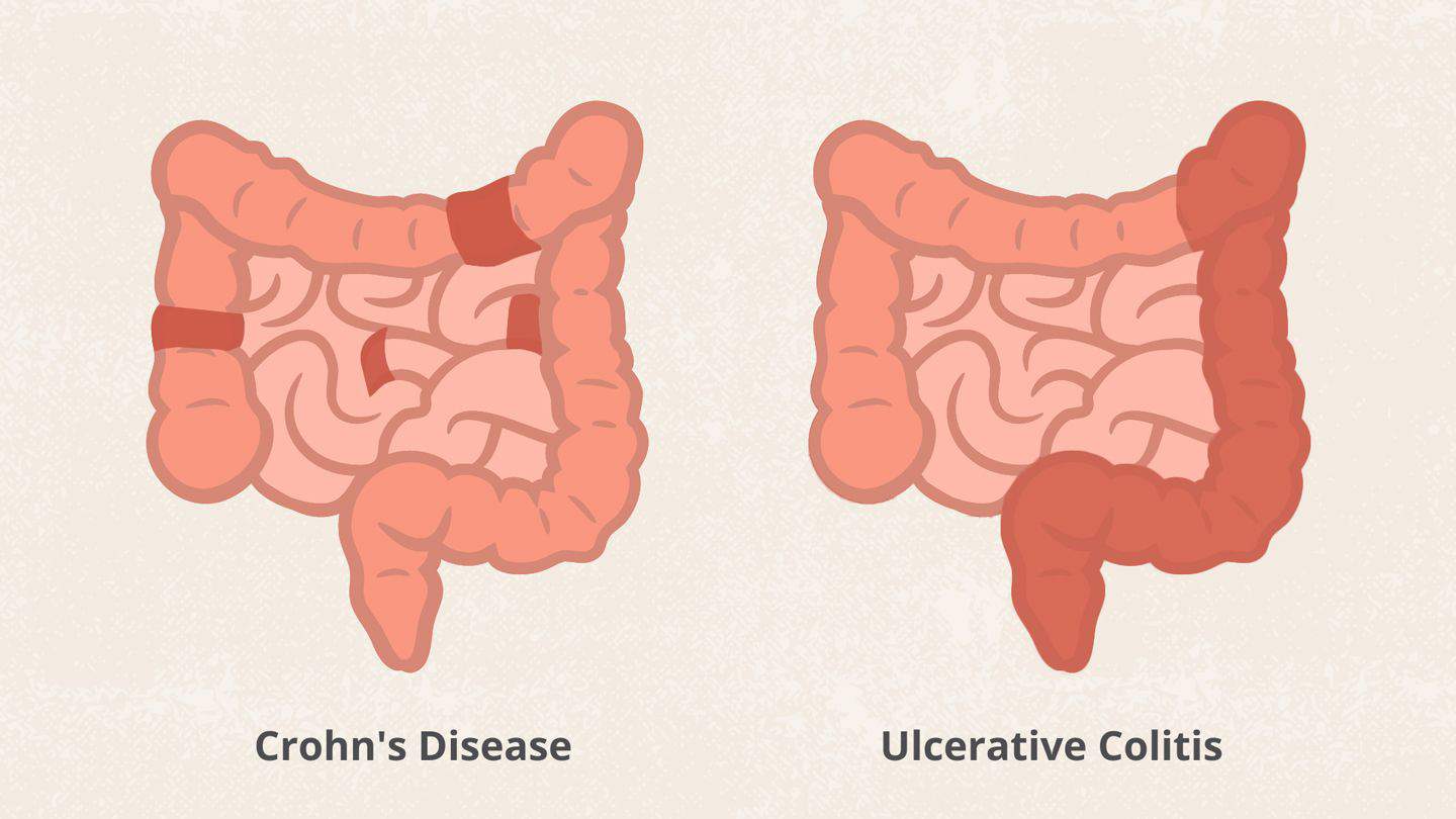 difference between crohns and uc alt 1440x810 1