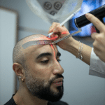 Hair Transplant