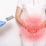 Tratamiento de la colitis ulcerosa / enfermedad de Crohn