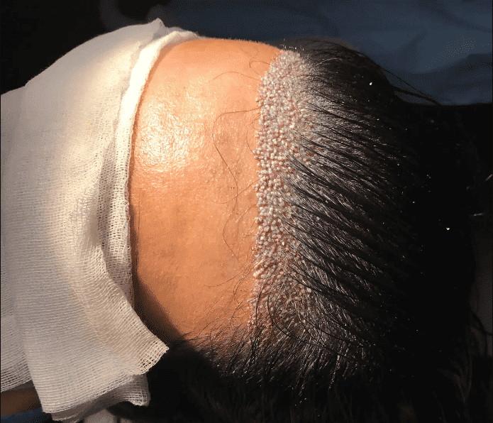 women hair transplant turkey